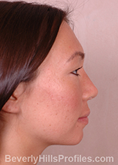 Female face, after Asian Rhinoplasty treatment, right side view, patient 1