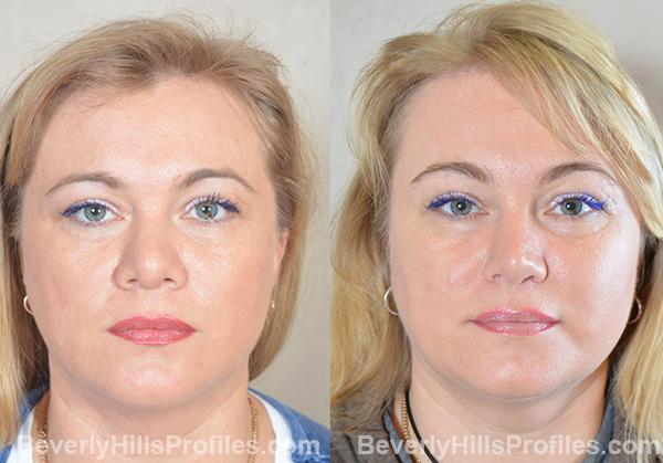 Revision Rhinoplasty Before and After Photo Gallery - front view, female patient 27