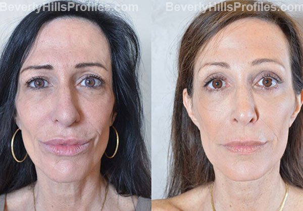 Female face, before and after Browlift treatment, front view, patient 1