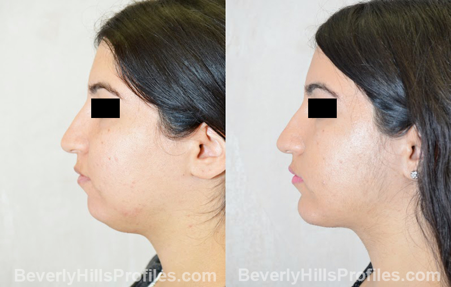 before and after Chin Implants - side view