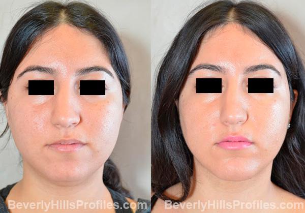 Female face, before and after Chin Implant treatment, front view, patient 5