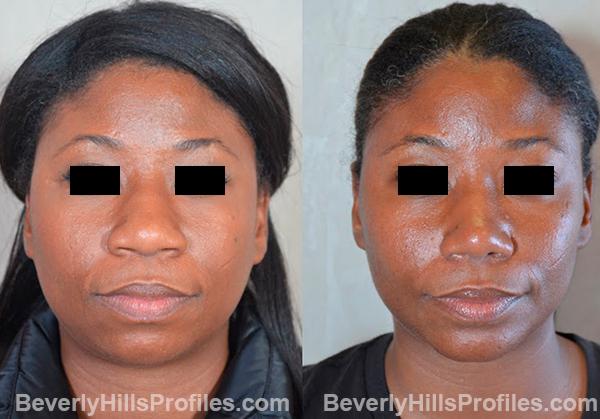 Female face, before and after Chin Implant treatment, front view, patient 6