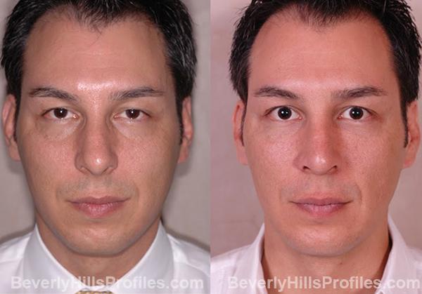Male face, before and after Chin Implant treatment, front view, patient 1