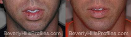 Male face, before and after Chin Implant treatment, front view, patient 7