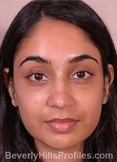 Young woman's face, after ethnic rhinoplasty treatment, front view, patient 1