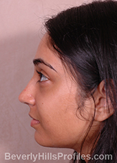 Young woman's face, after ethnic rhinoplasty treatment, left side view, patient 1