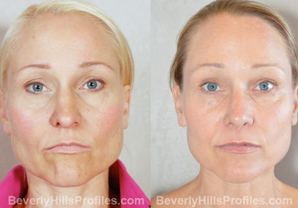 Female face, before and after Eyelid Lift treatment, front view, patient 4