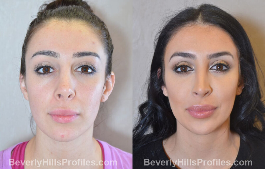 front view - Female patient before and after Facial Fat Transfer