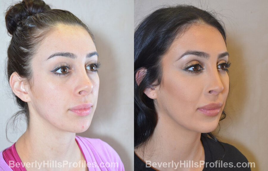 oblique view Female patient before and after Facial Fat Transfer Procedures