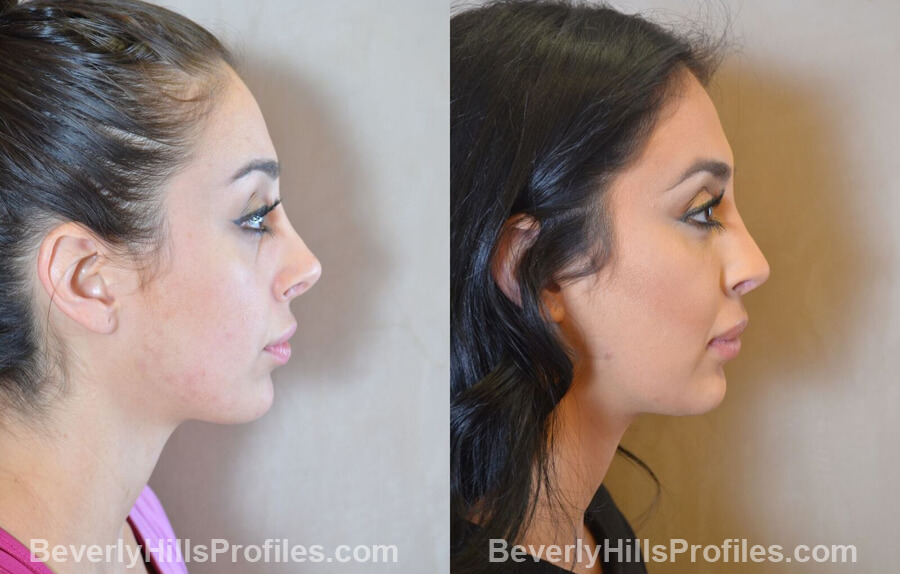 right side view - Female patient before and after Facial Fat Transfer