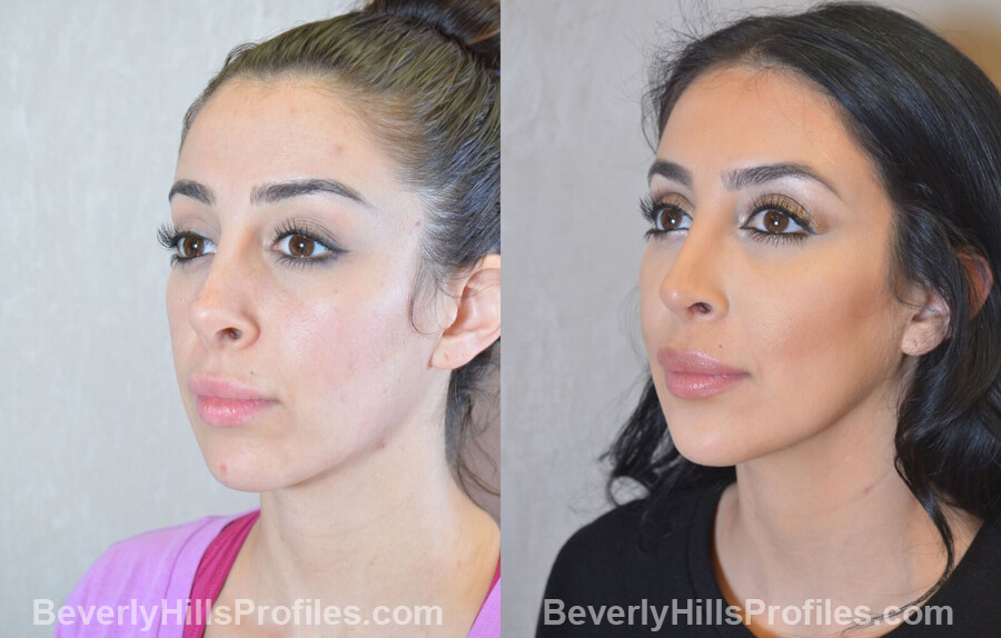 oblique view - Female patient before and after Facial Fat Transfer Procedures