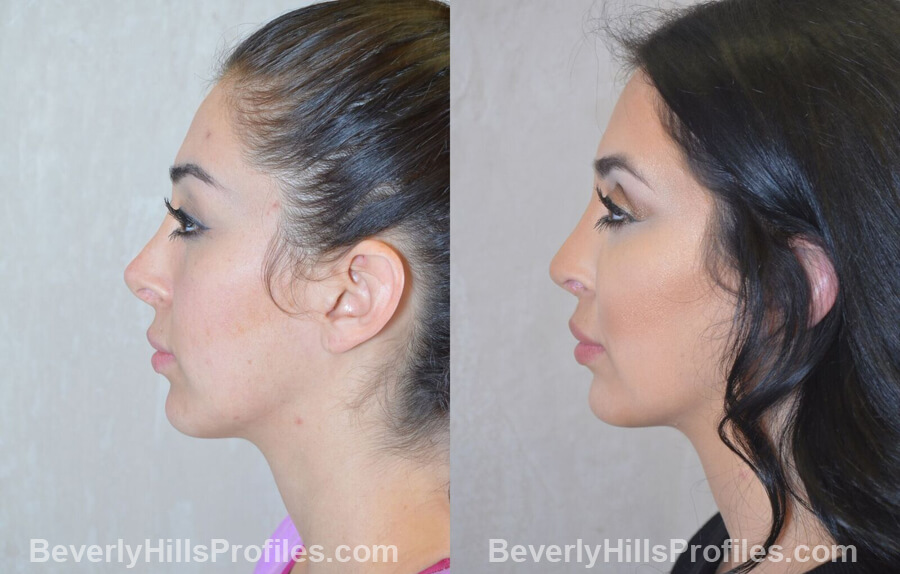 left side view - Female patient before and after Facial Fat Transfer