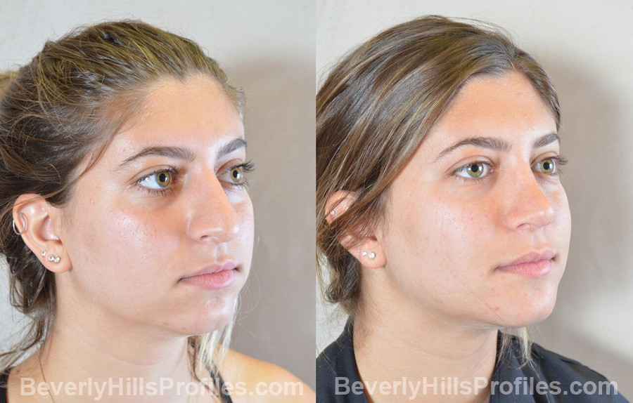 Female patient before and after Nose Surgery, oblique view