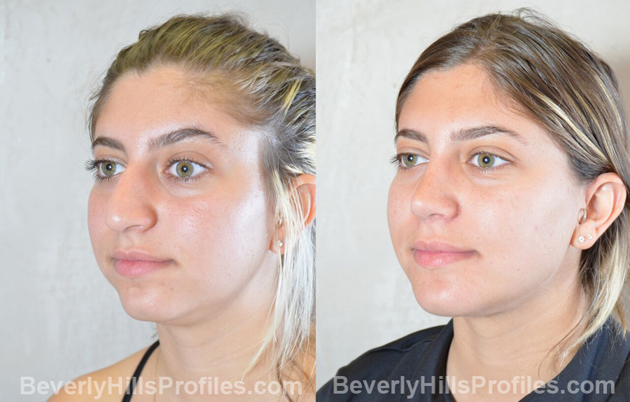 Female patient before and after Nose Surgery