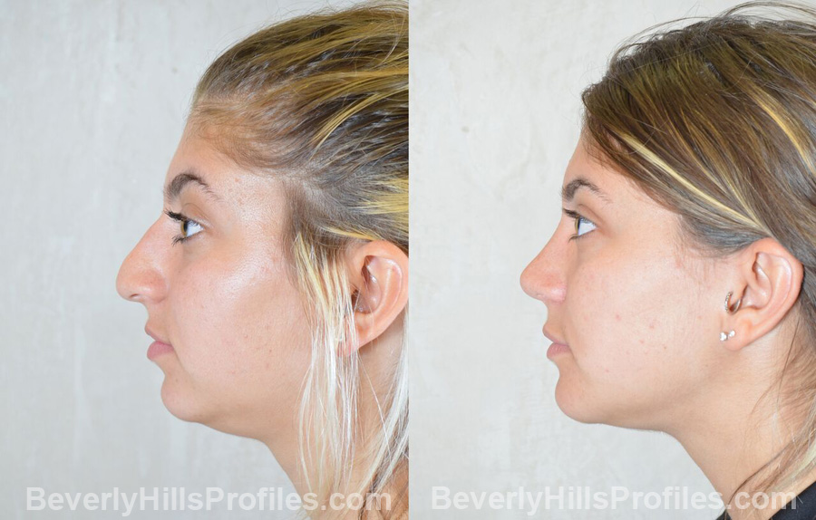 Female patient before and after Nose Surgery, side view