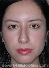 Female face, before Hispanic rhinoplasty treatment, front view, patient 1