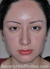 Female face, after Hispanic rhinoplasty treatment, front view, patient 1