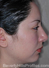 Female face, after Hispanic rhinoplasty treatment, right side view, patient 1