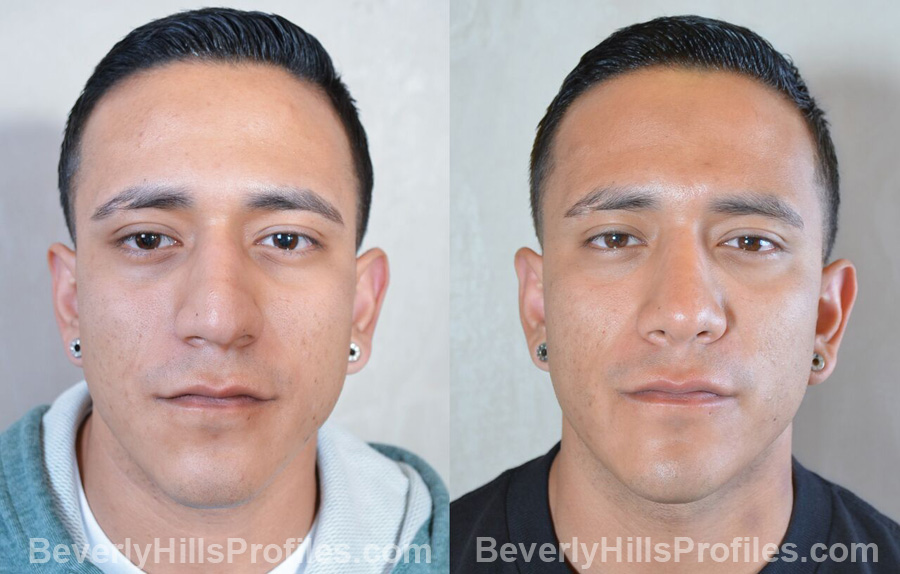 Male patient before and after Nose Surgery front view