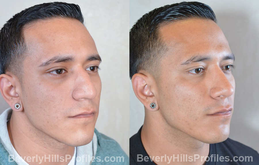 Male patient before and after Nose Surgery oblique view