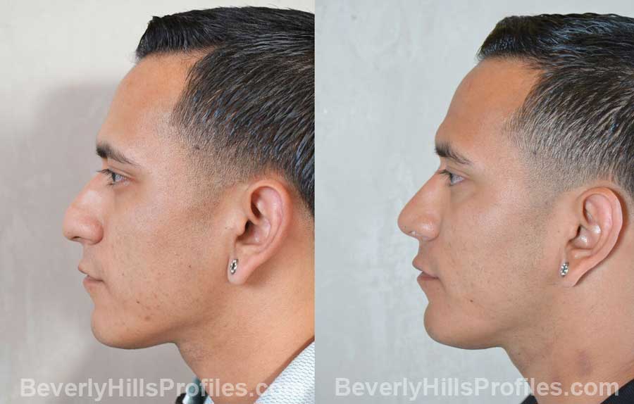 Male patient before and after Nose Surgery side view