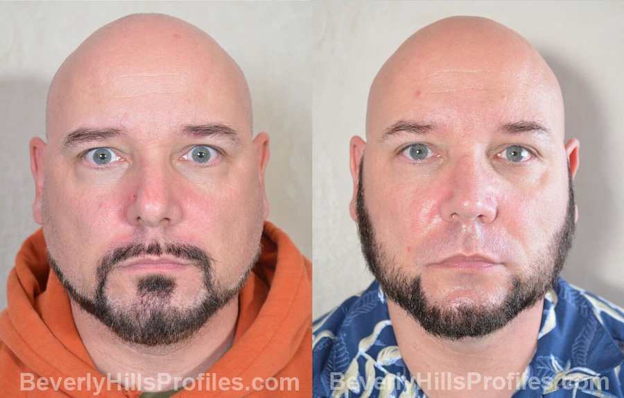 pics Male patient before and after Nose Surgery front view