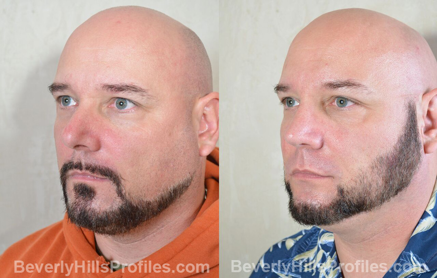 pics Male patient before and after Nose Surgery oblique view