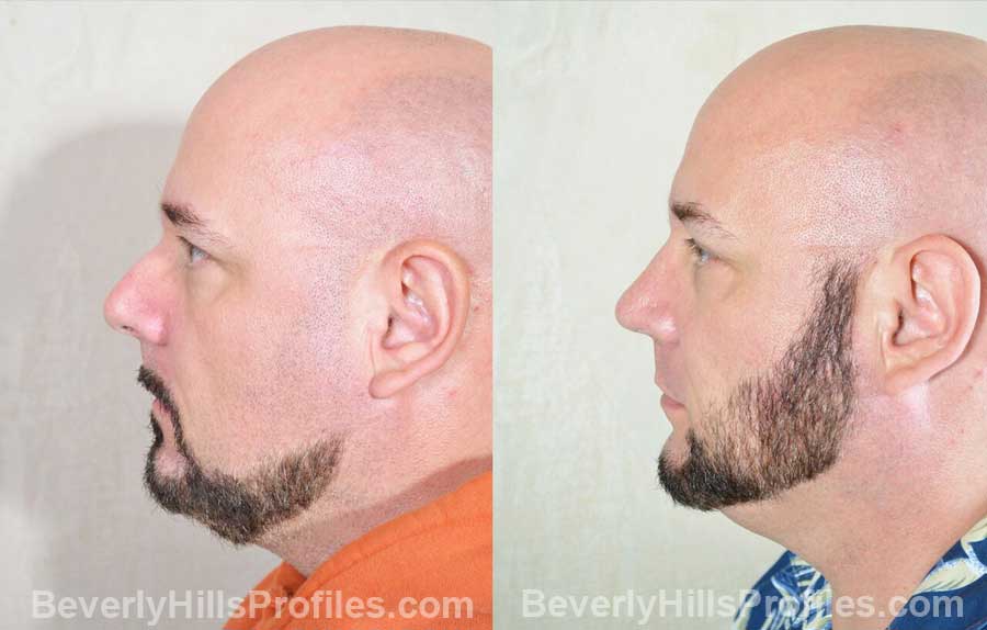 pics Male patient before and after Nose Surgery side view