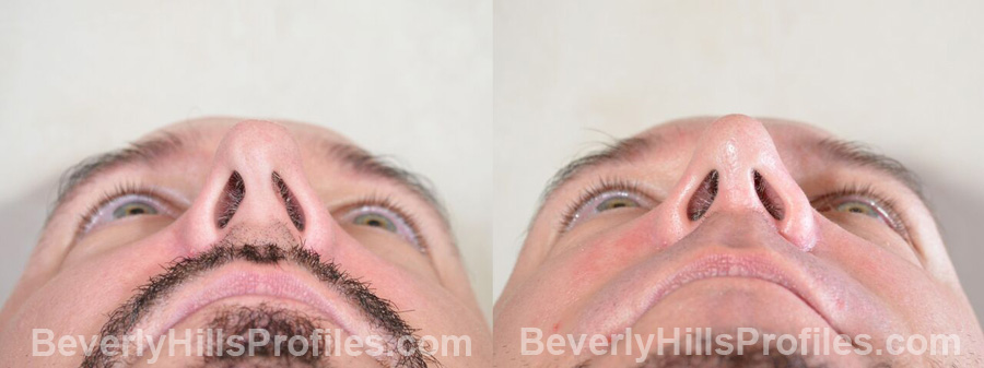 pics Male patient before and after Nose Surgery underside view