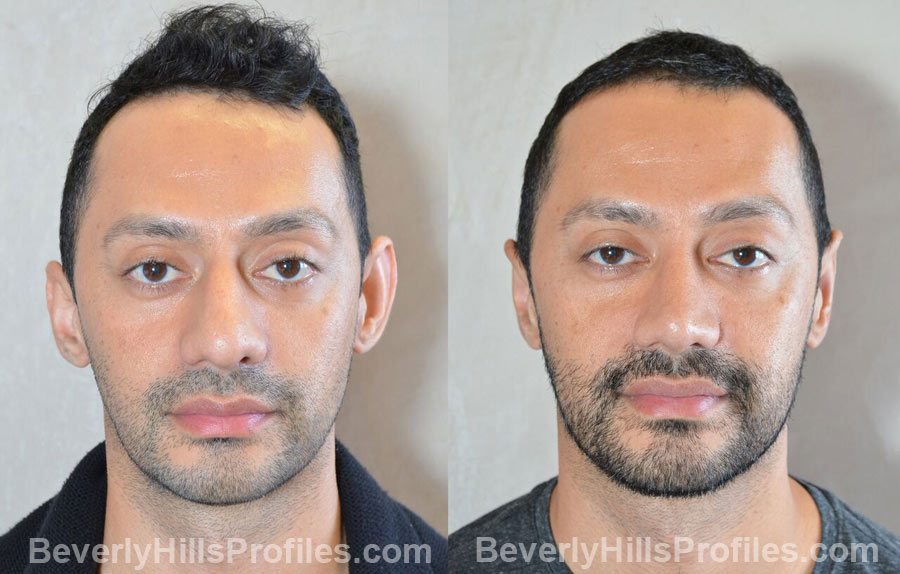 Male patient before and after Nose Surgery, front view