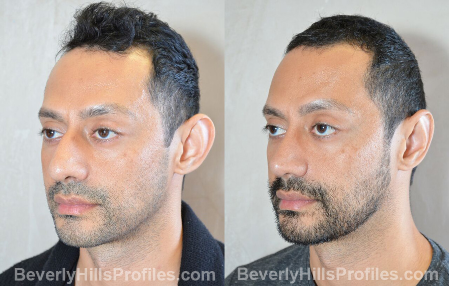 Male patient before and after Nose Surgery, oblique view