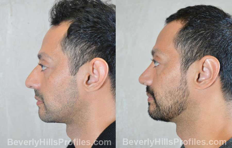 Male patient before and after Nose Surgery, side view