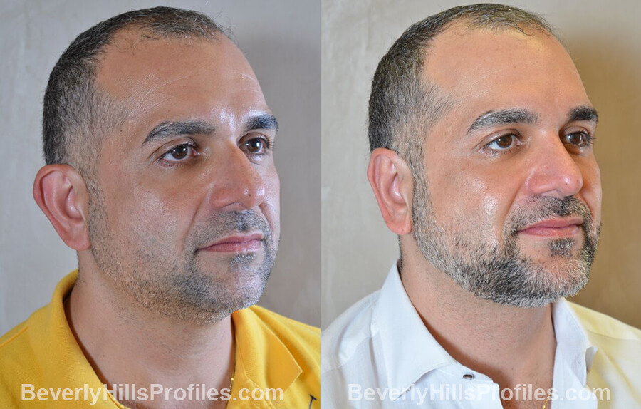 photos Male patient before and after Nose Surgery - oblique view