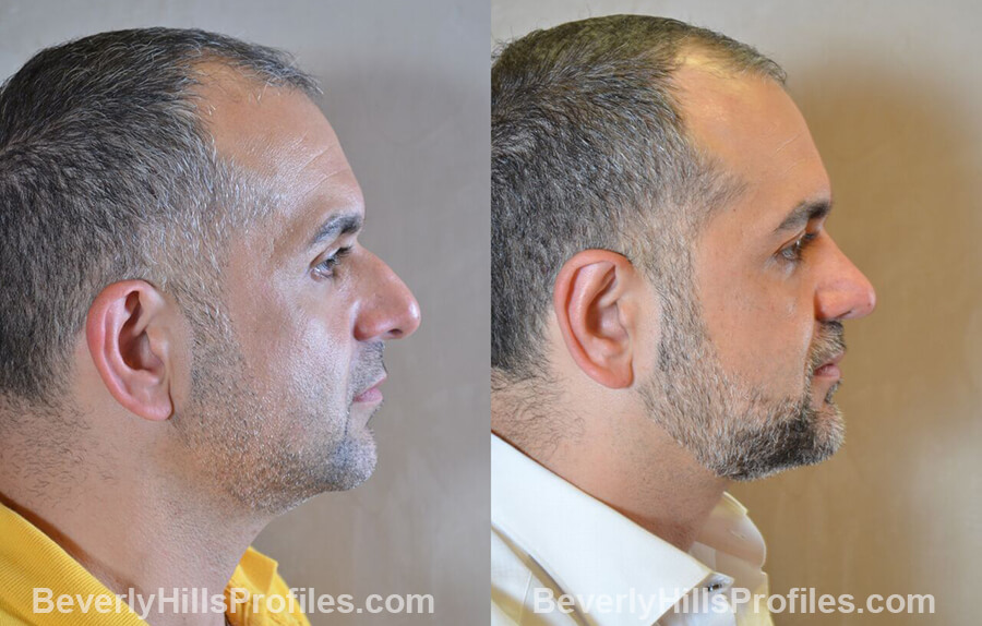 photos Male patient before and after Nose Surgery - right side view