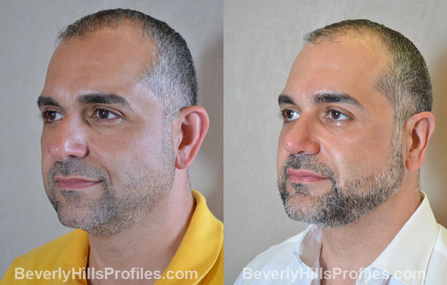 photos Male patient before and after Nose Surgery - left oblique view