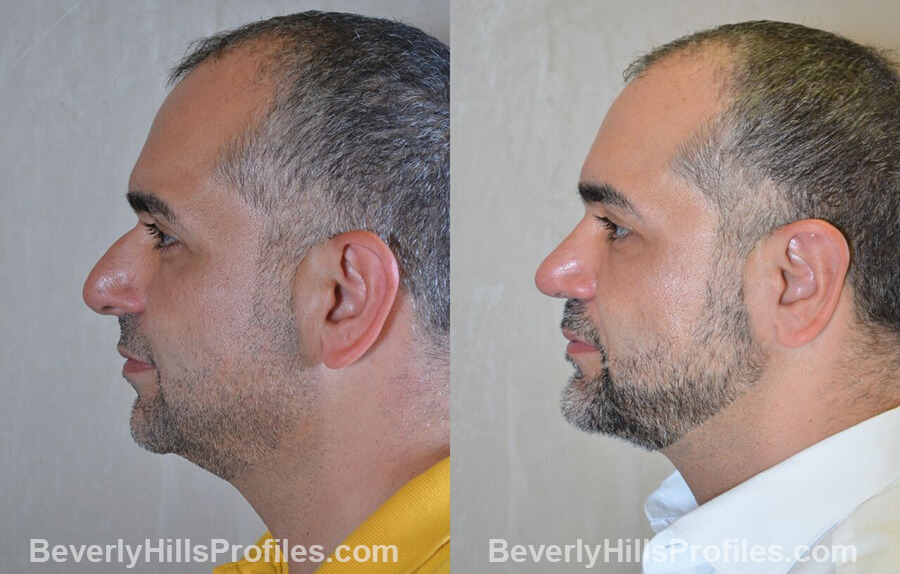 photos Male patient before and after Nose Surgery - left side view