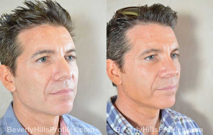 photos Male patient before and after Nose Surgery Procedures - oblique view