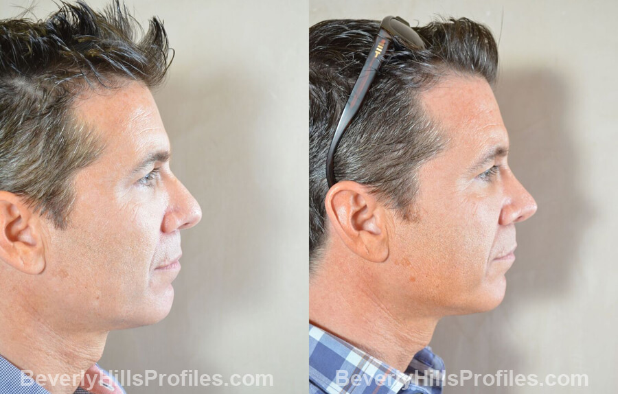 photos Male patient before and after Nose Surgery Procedures - right side view
