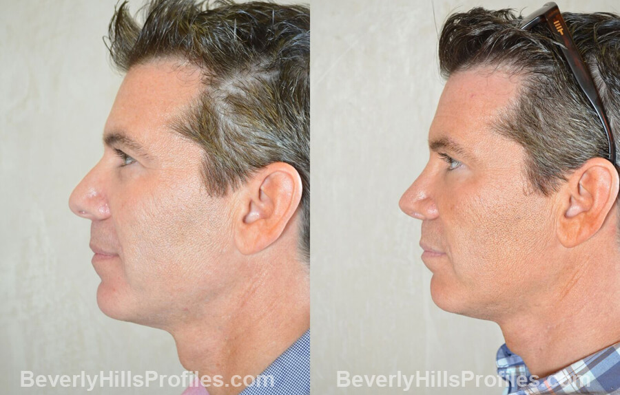 photos Male patient before and after Nose Surgery Procedures - left side view