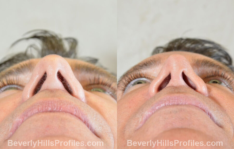 photos Male patient before and after Nose Surgery Procedures - underside view