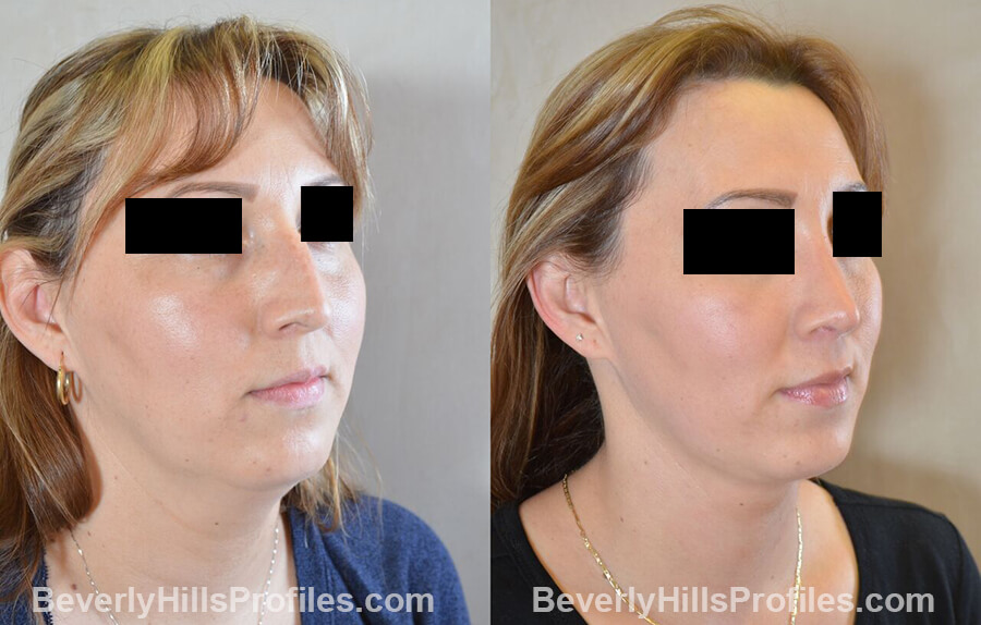 photos female patient before and after Necklift - oblique view