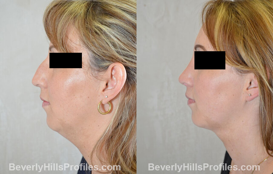 photos female patient before and after Necklift - left side view