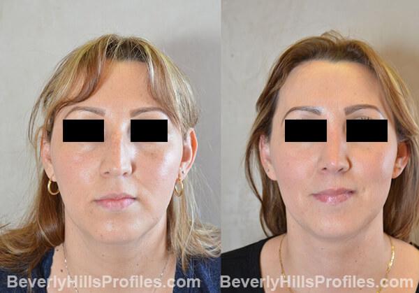 pics female patient before and after Necklift - front view