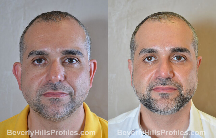 photos male patient before and after Necklift - front view