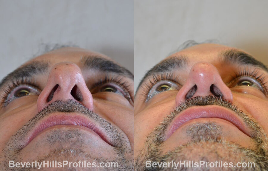 photos male patient before and after Necklift - underside view