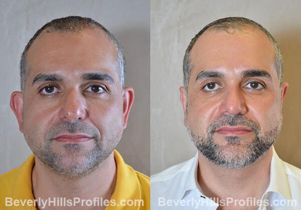 pics male patient before and after Necklift - front view