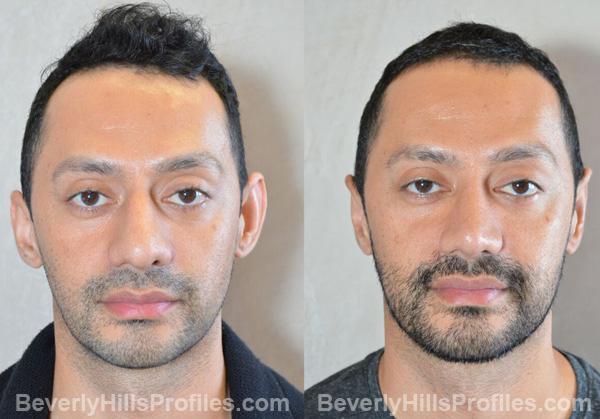 photos before and after Otoplasty Procedures
