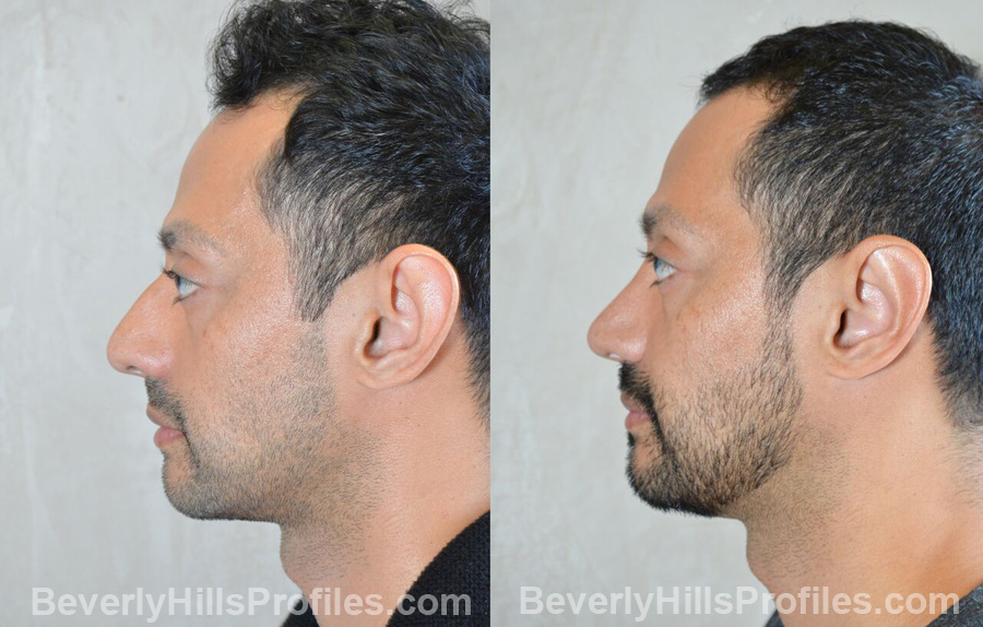 images male patient before and after Otoplasty Procedures - left side view