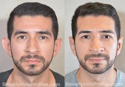 male patient before and after Otoplasty