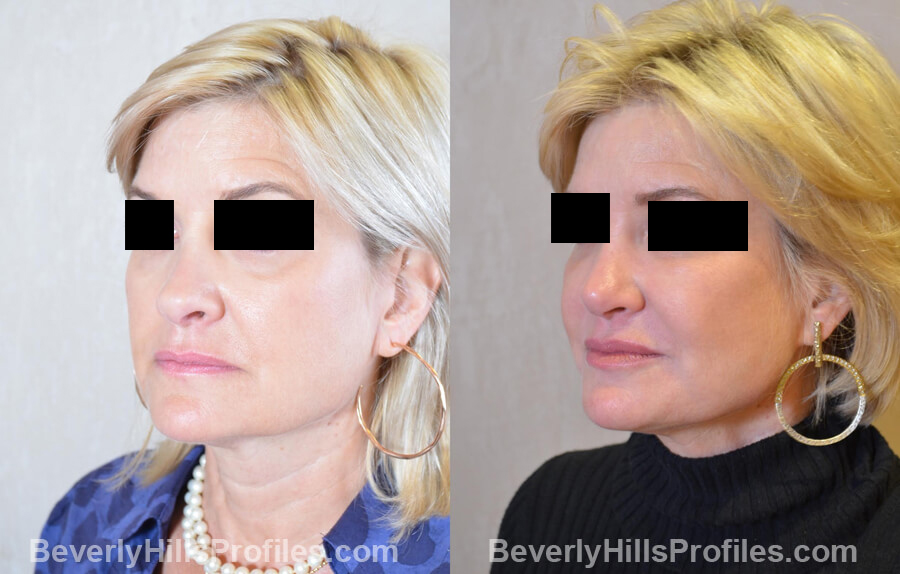 Photos Female patient before and after Revision Nose Job, left side view